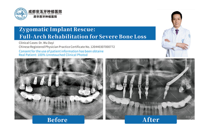 Extreme Bone Loss Zygomatic Restoration