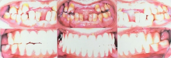 Before and after full-arch All-on-4 dental implant treatment showing facial and occlusal restoration from front, left, and right profile views.