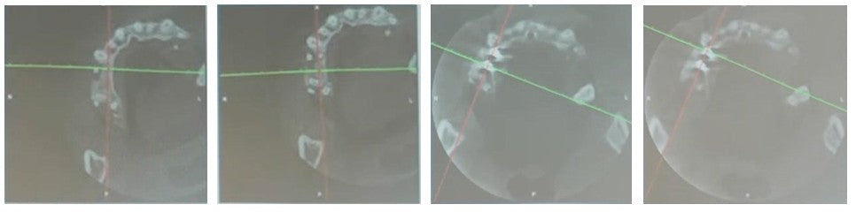 Axial CBCT scans at Tooth 14 (FDI #14 / Universal #4) site showing buccolingual implant position, spatial gap management for GBR, and transverse bone contour regeneration across 7 months.