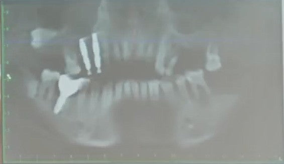 Post-operative panoramic CBCT scan confirming proper parallel alignment, vertical depth, and inter-implant spacing at Tooth 14 (FDI #14 / Universal #4) and Tooth 15 in the upper right quadrant.