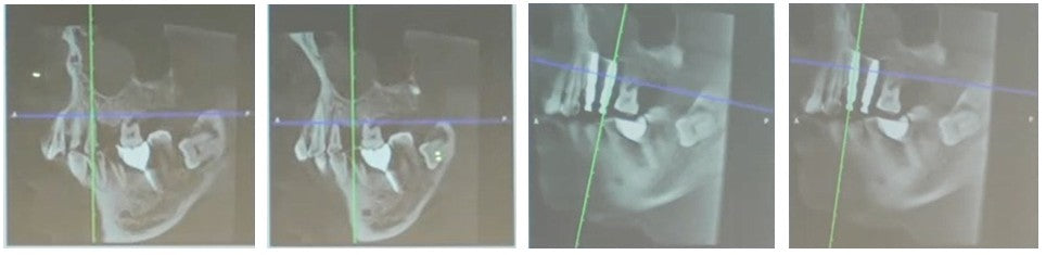 Parasagittal CBCT scan series of Tooth 14 (FDI #14 / Universal #4) demonstrating palatal bone wall support and long-term radiographic bone healing around the implant over 7 months.