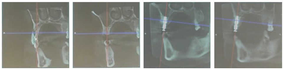 Four-stage sagittal CBCT scans of Tooth 14 (FDI #14 / Universal #4) showing complete buccal bone defect before extraction, post-extraction socket, immediate palatal-oriented implant placement, and 7-month bone graft integration.