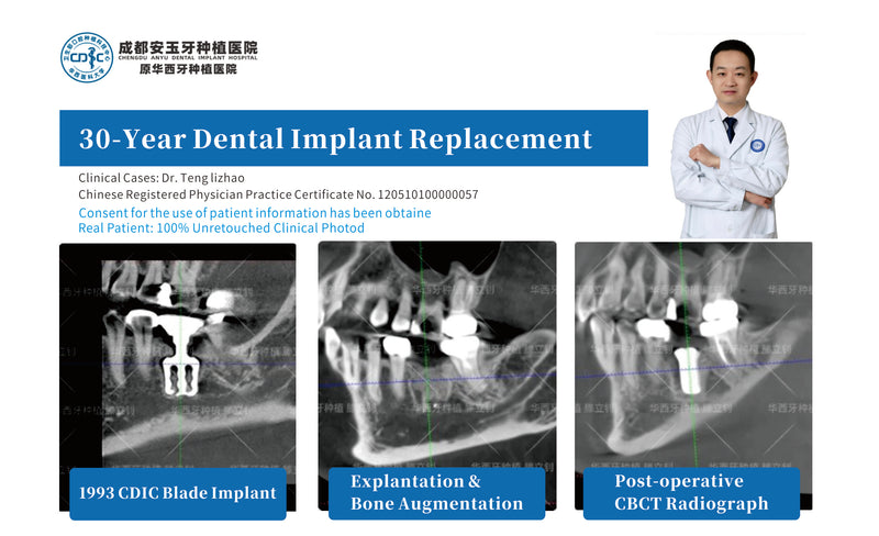 30-Year Failed Implant Revision