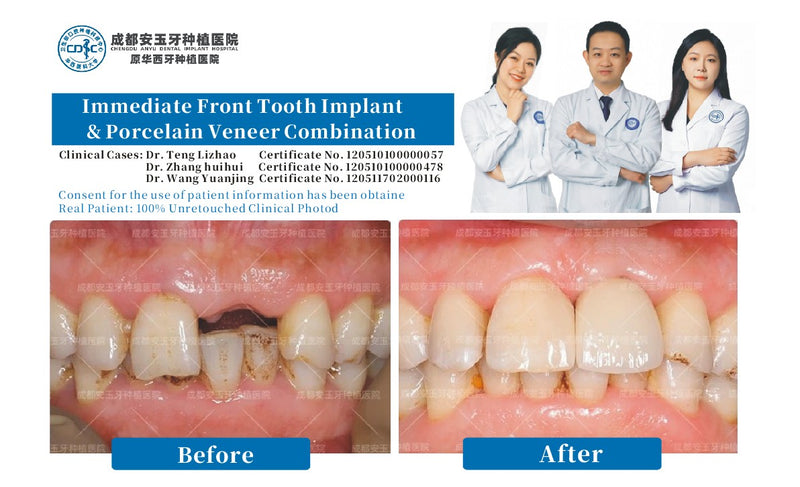 Anterior Immediate Implant & Veneer Makeover