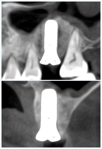 Postoperative CBCT showing dental implant placement with satisfactory three-dimensional positioning and stable peri-implant bone support