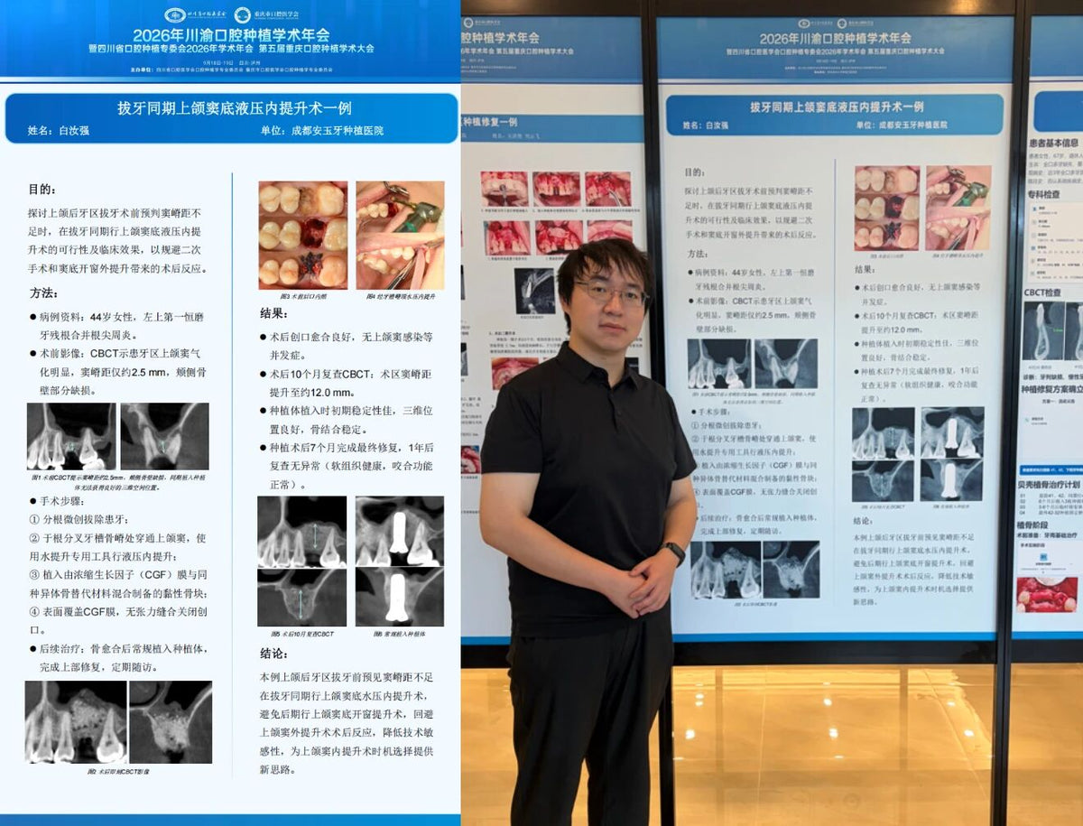 Dr. Bai Ruqiang standing next to his poster presentation on transcrestal hydraulic sinus elevation at the 2026 Joint Sichuan-Chongqing Dental Implantology Annual Conference.