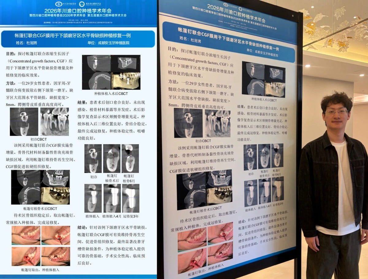Dr. Du Guannan standing next to his poster presentation on transcrestal hydraulic sinus elevation at the 2026 Joint Sichuan-Chongqing Dental Implantology Annual Conference.