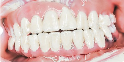 Final intraoral frontal view showing complete upper and lower full-arch fixed prosthesis delivering a functional, aesthetic smile.
