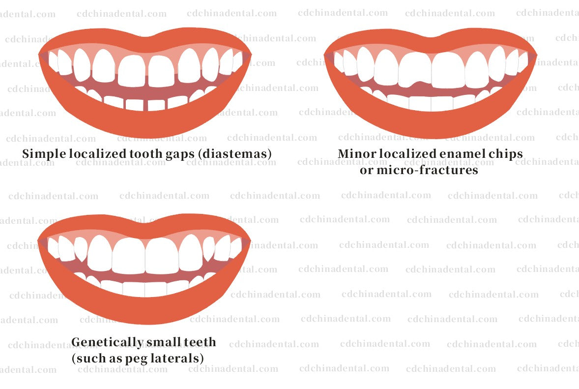 Ultra-Conservative Enhancements with Zero Enamel Reduction