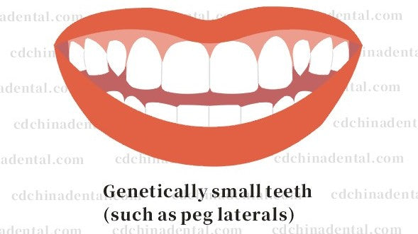 No-prep ultra-thin veneers reshaping genetically small peg lateral teeth in Chengdu, China