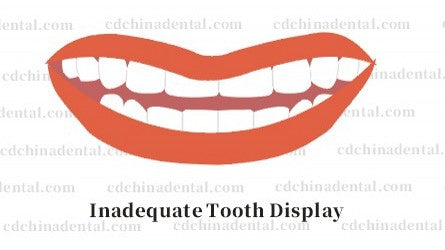 Enhancing hidden smile display and tooth visibility with aesthetic veneers in Chengdu, China