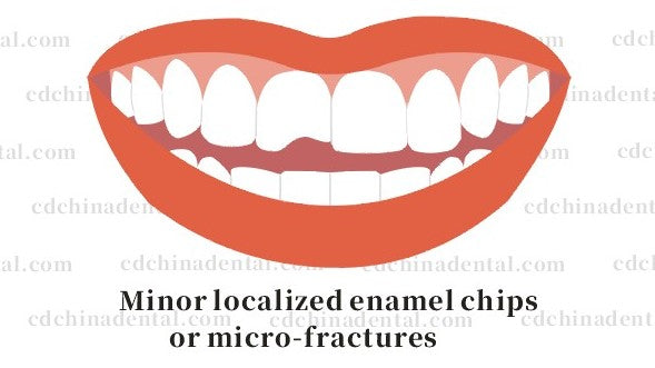 Minimally invasive no-prep veneers repairing chipped front tooth edges in Chengdu, China