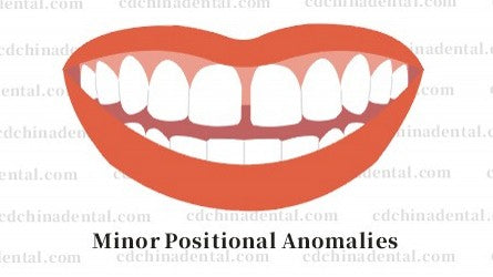 Visual realignment of mildly rotated teeth using cosmetic dental veneers in Chengdu, China