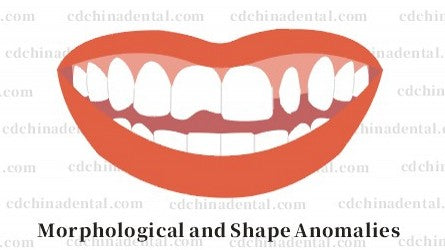 Correction of peg laterals and misshapen teeth with custom porcelain veneers in Chengdu, China