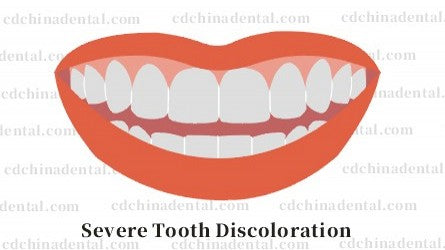 Severe intrinsic tooth discoloration before and after porcelain veneer treatment in Chengdu, China