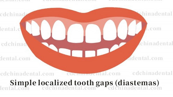 No-prep porcelain veneers for non-invasive gap closure and diastema repair in Chengdu, China