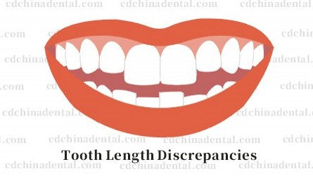 Porcelain veneers for lengthening worn and uneven front teeth in Chengdu, China