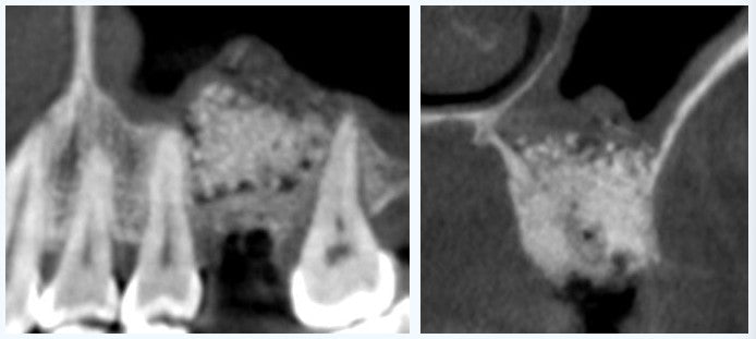 Immediate postoperative CBCT showing transcrestal hydraulic sinus elevation and viscous bone grafting performed