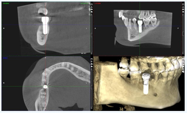 Postoperative CBCT confirming accurate 3D implant positioning and surrounding augmented bone height and width.