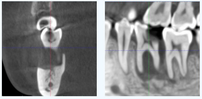 Preoperative CBCT showing severe horizontal alveolar ridge defect in the right mandibular molar area.