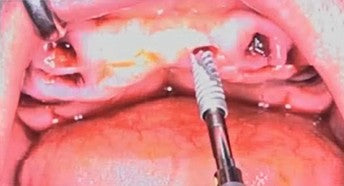 Intraoperative photo showing active placement of dental implants into the maxillary bone with optimized AP spread.