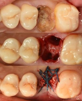 Intraoral clinical photographs showing residual roots, fresh extraction socket, and tension-free wound closure with CGF membrane