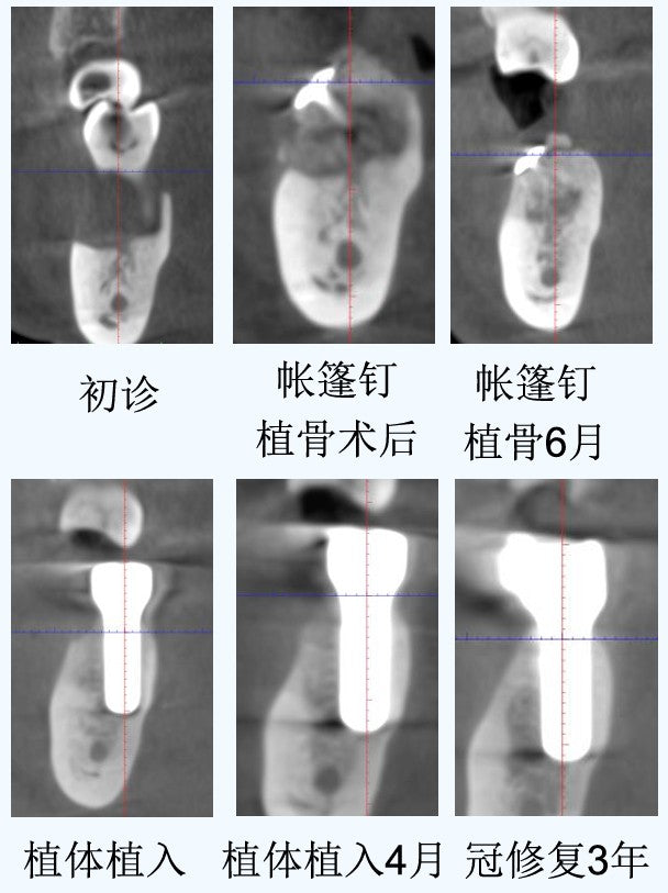 Longitudinal cross-sectional CBCT comparison from initial presentation, tent pole grafting, implant placement, to 3-year post-restoration follow-up.