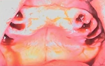 Intraoperative view of the upper jaw following phased minimal-trauma extractions prior to implant insertion.