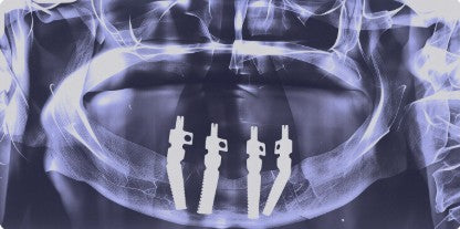 Post-operative CBCT scan displaying four successfully placed CDIC implants in the mandible for an All-on-4 full-arch restoration.