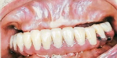 Post-operative intraoral frontal view displaying the custom immediate fixed provisional denture installed on the lower arch.