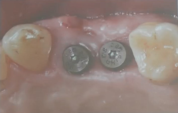 Post-operative intraoral occlusal view showing two dental implants with healing abutments connected in the right maxillary premolar site at Tooth 14 (FDI #14 / Universal #4) and Tooth 15.