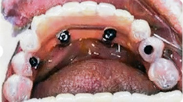 Occlusal intraoral view of the lower jaw following All-on-4 CDIC implant placement and multi-unit composite abutment installation.