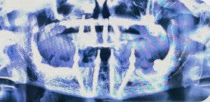 Post-operative CBCT scan displaying 4 strategically placed dental implants per arch in upper and lower jaws for full-arch reconstruction.