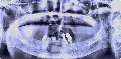 Pre-operative CBCT scan of a 90-year-old female patient showing severe osteoporosis and residual teeth in the maxilla and mandible.