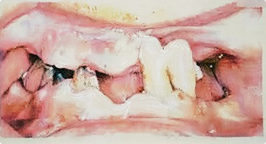 Pre-operative extraoral closed-mouth view of the 90-year-old patient showing vertical dimension loss due to edentulism.