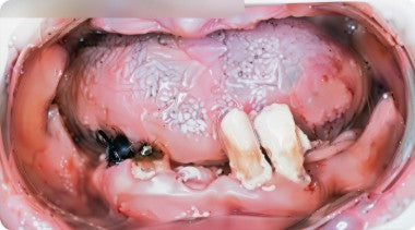 Pre-operative intraoral view showing remaining teeth and residual roots in both upper and lower arches before All-on-4 surgery.