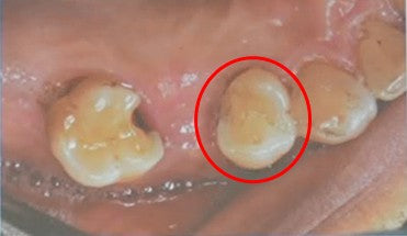 Pre-operative intraoral occlusal view highlighting Tooth 14 (FDI #14 / Universal #4) (red circle) with severe periodontitis and Grade III mobility prior to extraction.