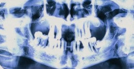 Pre-operative CBCT scan showing severe maxillary bone resorption and compromised dentition prior to full-arch implant surgery.
