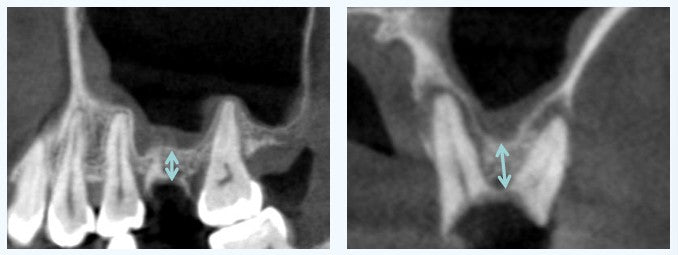 Preoperative CBCT showing residual bone height of approximately 2.5 mm and partial buccal bone defect prior to hydraulic sinus lift