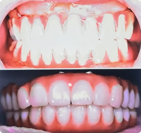 Comparison of 8-hour same-day provisional acrylic bridge (top) and final high-strength all-ceramic restoration (bottom).
