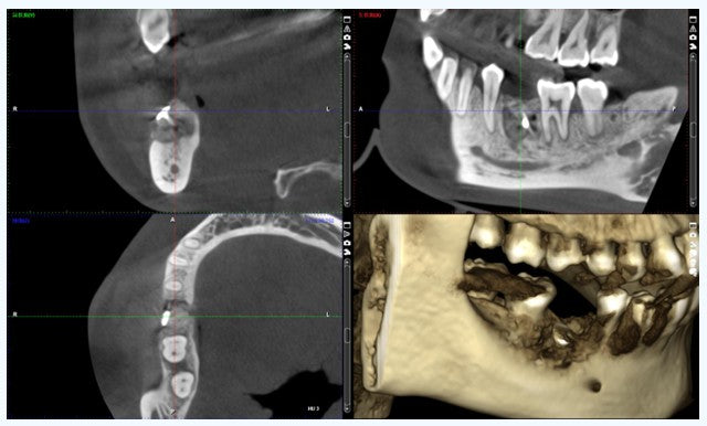 6-month postoperative CBCT after tent pole bone grafting with CGF, showing significant horizontal ridge expansion and stable bone volume.