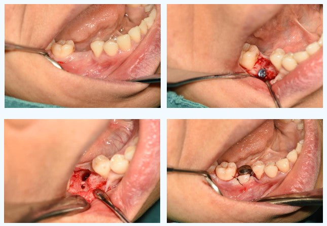 Clinical surgical steps showing tent pole screw retrieval and dental implant placement in newly augmented bone.
