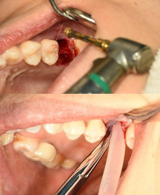 Surgical procedure of transcrestal hydraulic sinus floor elevation using dedicated instruments
